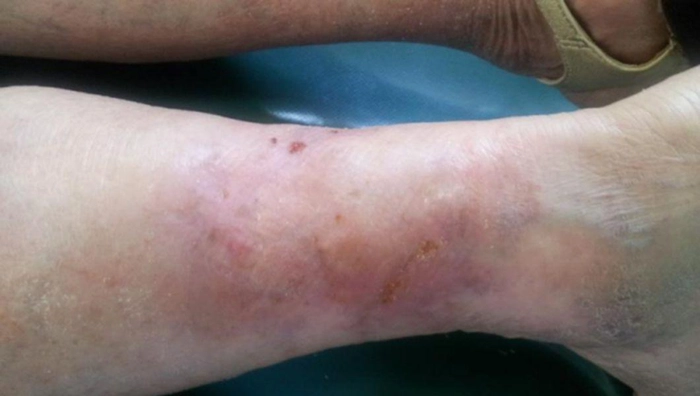 persoană care are ulcer varicos