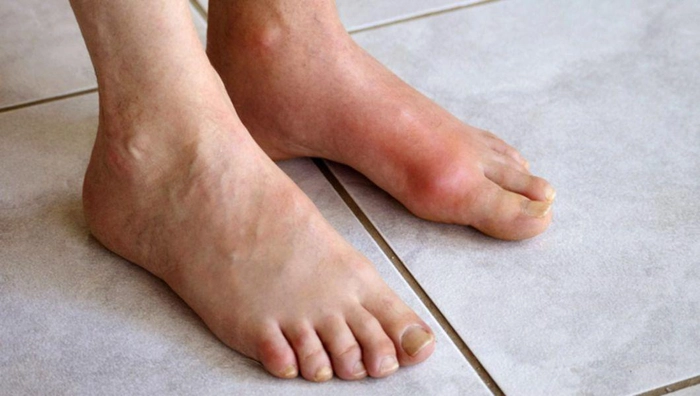 persoana care sufera de guta