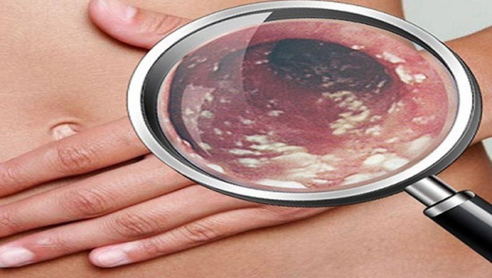 bacterii candidoza