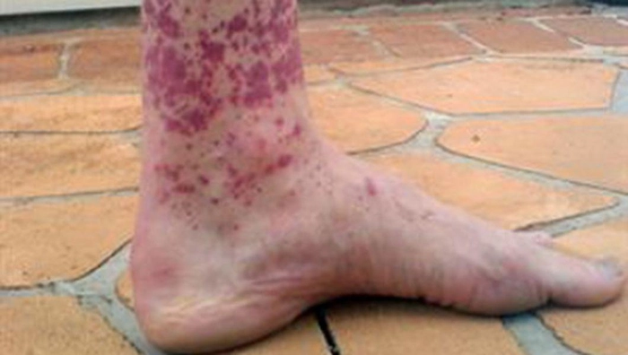 picior afectat de purpura trombocitopenica autoimuna