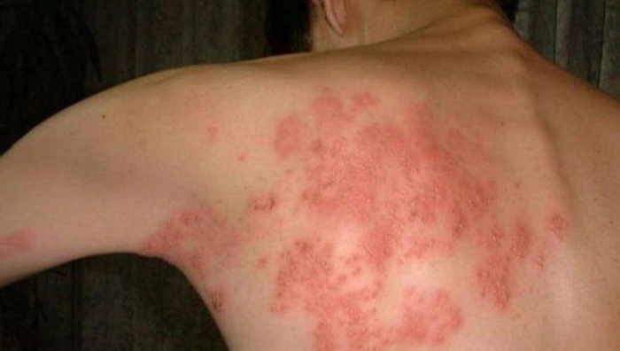 persoana care sufera de eruptii cutanate provocate de zona zoster pe spate