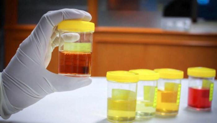 analiza de urina pentru a identifica prezenta de leucocite