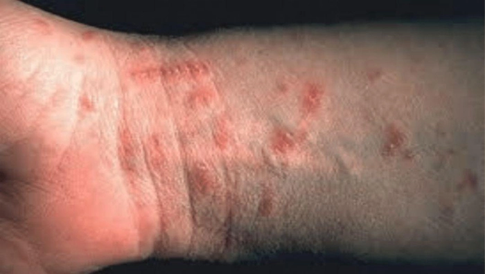 persoana care sufera de scabie 