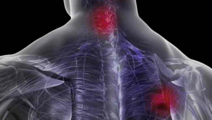 reprezentare spondiloza cervicala