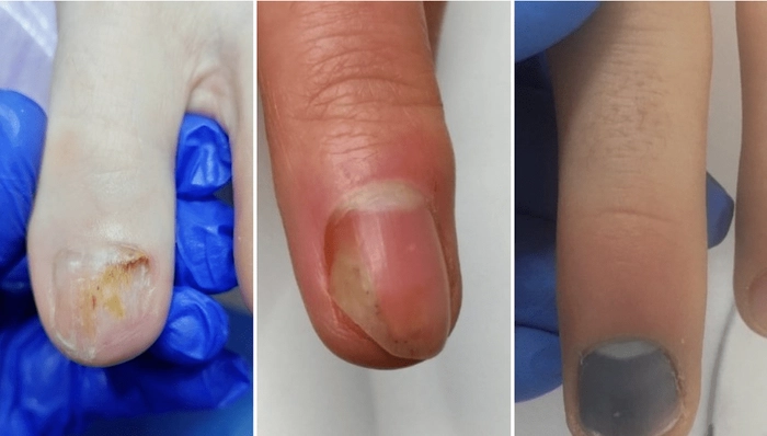 3 pasi ai infectiei la unghie