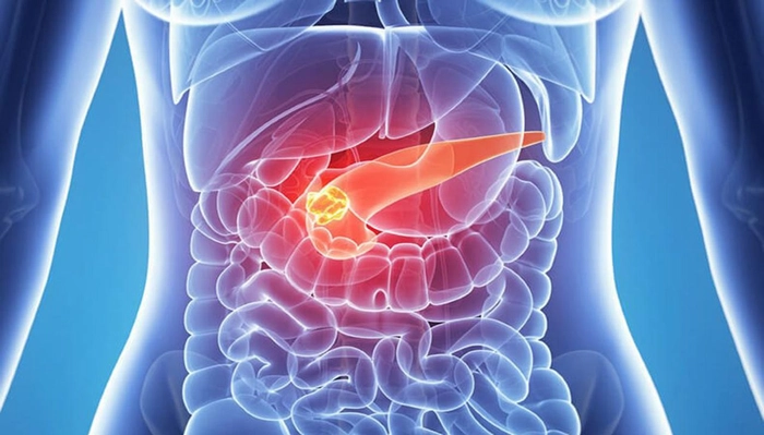 grafica pancreas afectat
