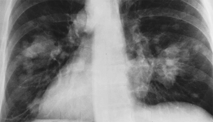 radiografie pulmonară