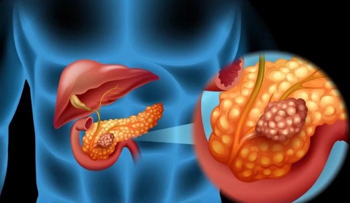 pancreasul-doare