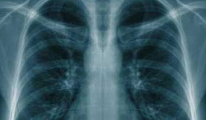 o radiografie pulmonară