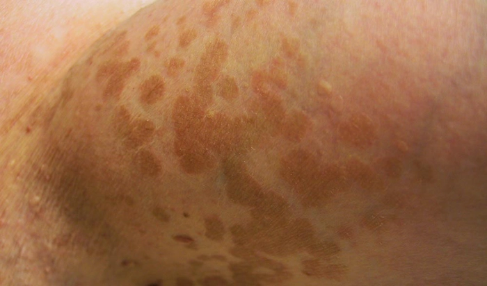 pitiriazis versicolor pe piele