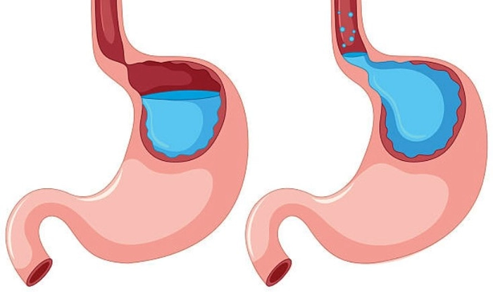 reprezentare reflux gastroesofagian