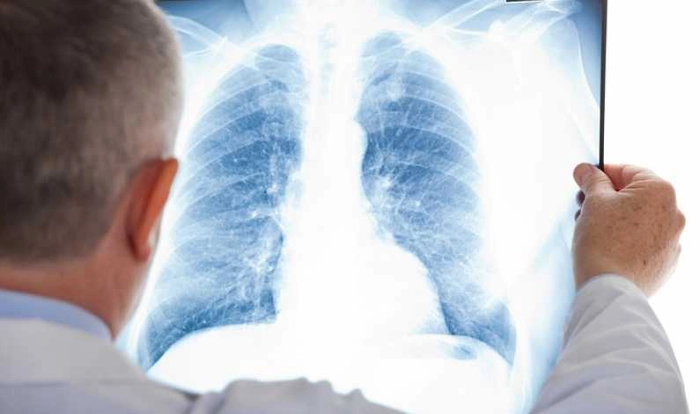 imagine cu o radiografie pulmonară