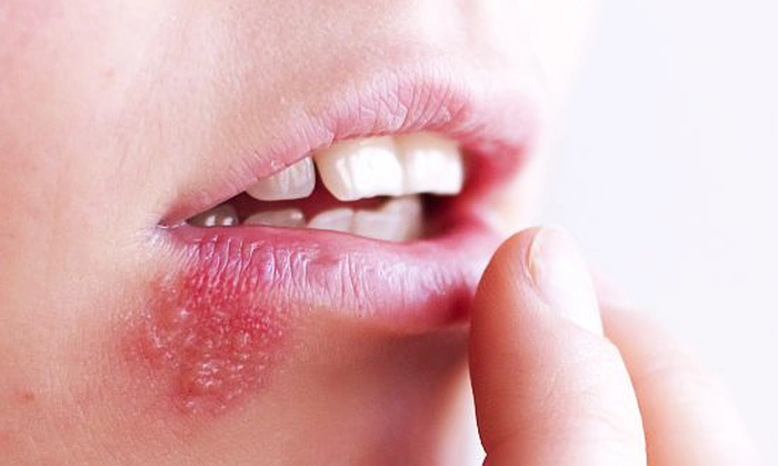 persoană care are herpes bucal