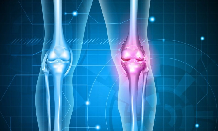 grafica osteoartroza