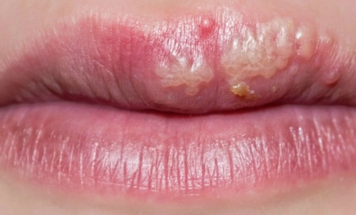 persoană care are herpes bucal