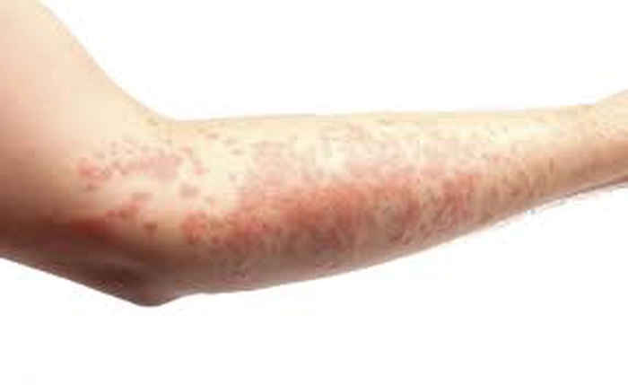 persoana care sufera de eczema