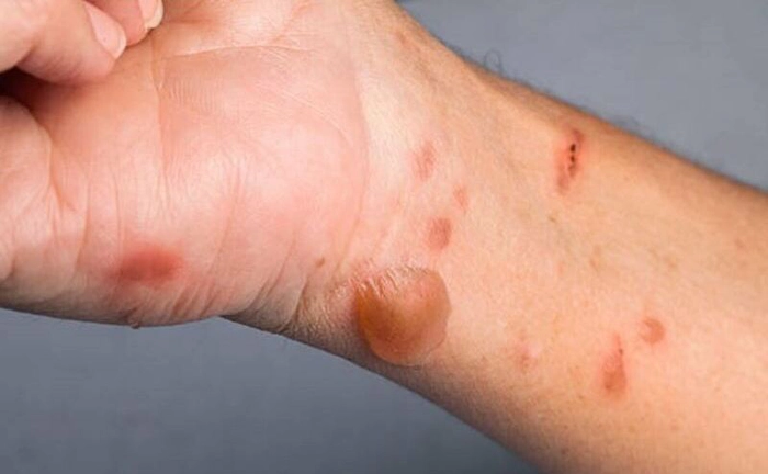 mana infectata cu noul virus al gripei tomatelor