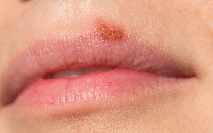 persoana bolnava de herpes oral
