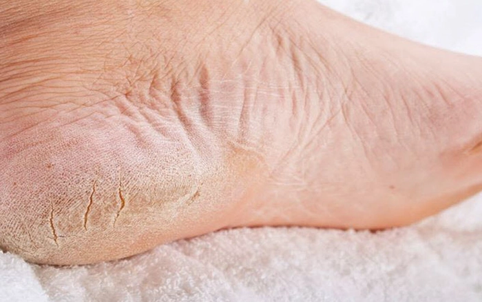 piciorul unei persoane care sufera de ciupera de piele