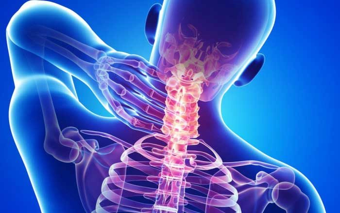 infografică persoană care suferă de spondiloză cervicală