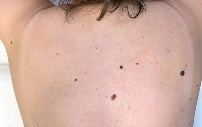 femeie care sufera de melanom pe spate