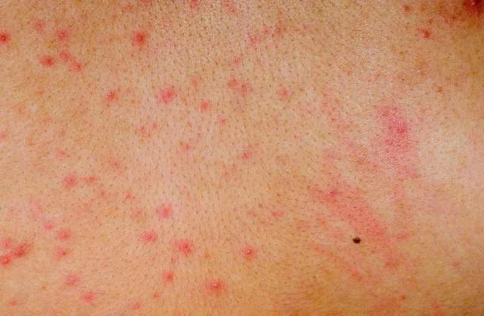 persoana care are bube aparute in urma unei toxiinfectii alimentare