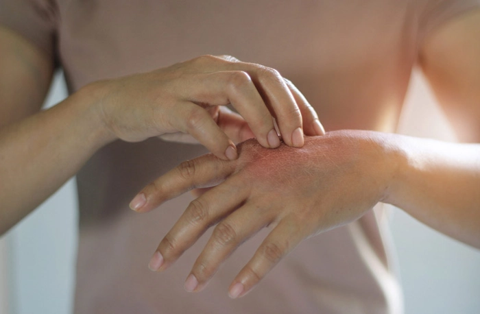 femeie care sufera de mancarimi din cauza unei alergii pe sistem nervos