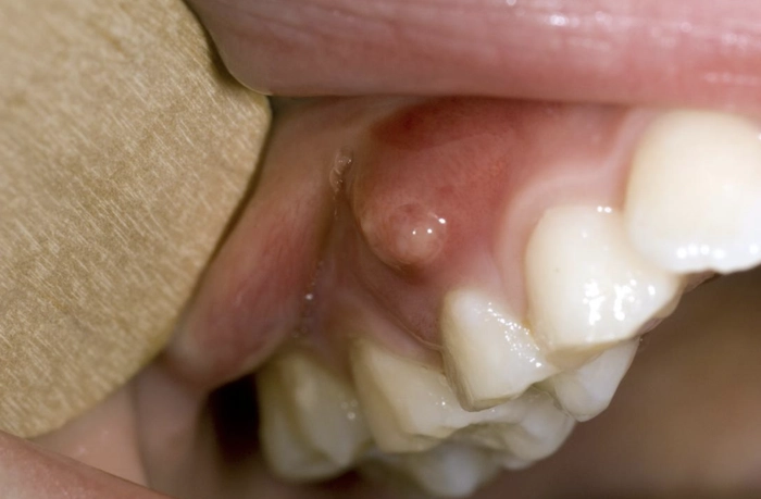 abces dentar la o masea