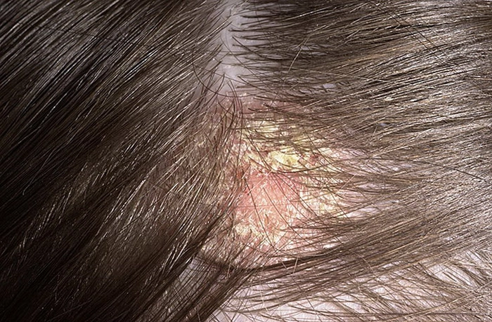persoana care sufera de o boala a scalpului