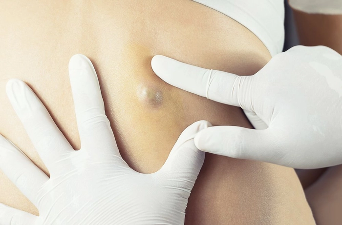medic care analizeaza un nodul sub piele pe spatele unei persoane
