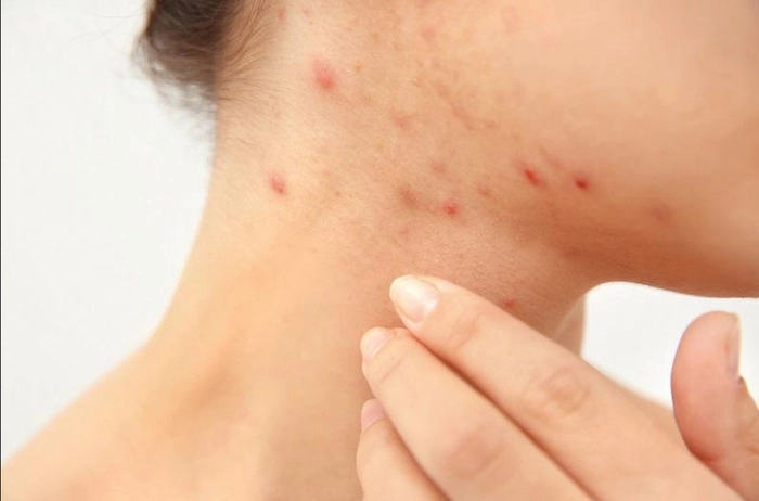 persoana care sufera de scabie pe fata
