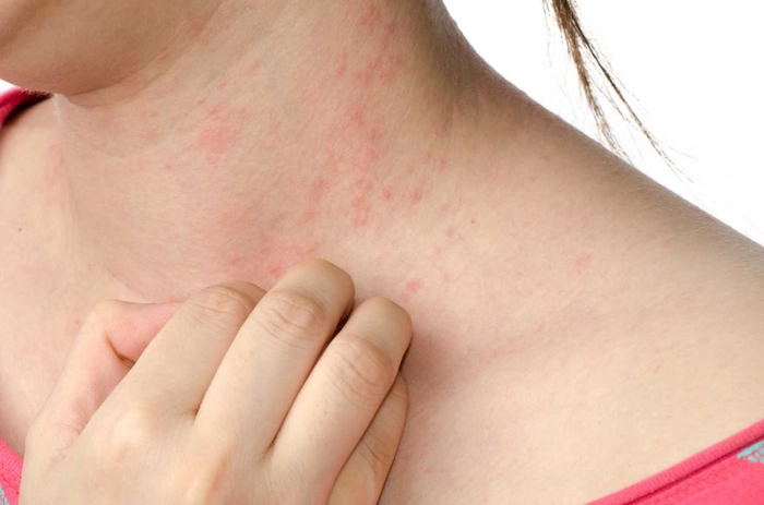 persoana care sufera de mancarime pe gat din cauza unei intepaturi de insecte