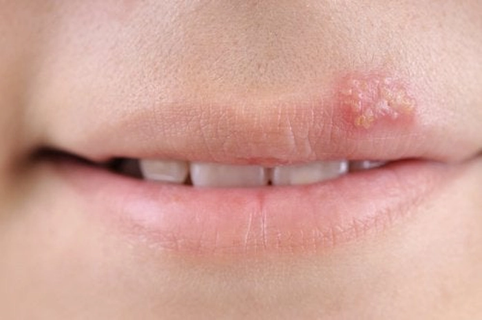persoană care suferăe herpes