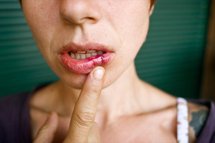 persoana bolnava de herpes oral care indica spre rana de pe buza de jos