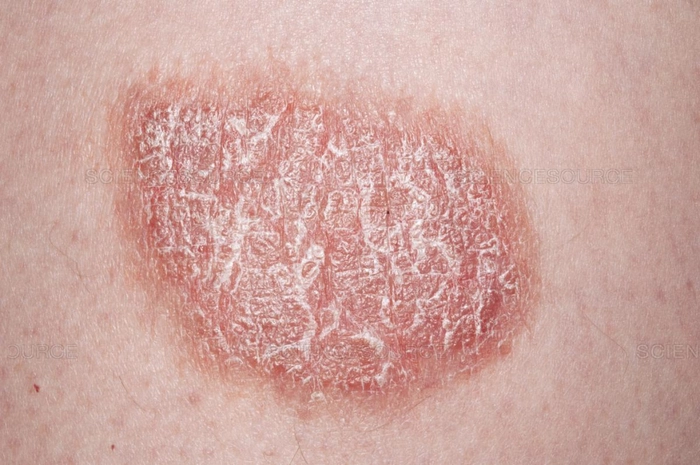 eruptie cutanata pe corpul unei persoane