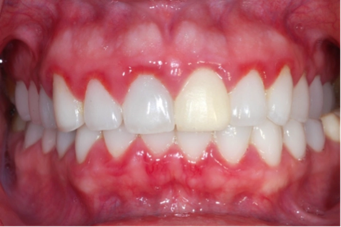 persoana care sufera de abces dentar
