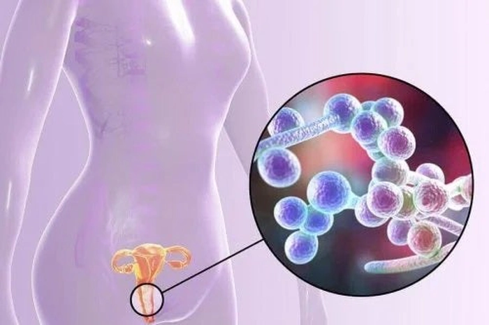 grafica candidoza vaginala