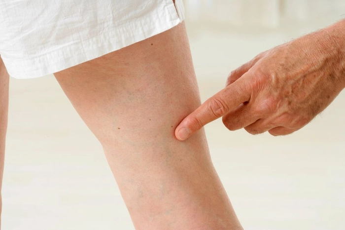 persoana care indica cu degetul spre piciorul unei alte persoane care sufera de trombofilie