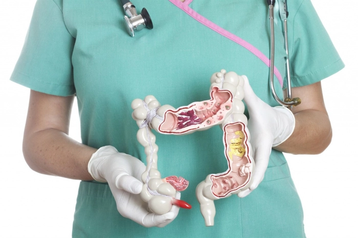 medic care tine o macheta a unui intestin afectat de cancer de colon