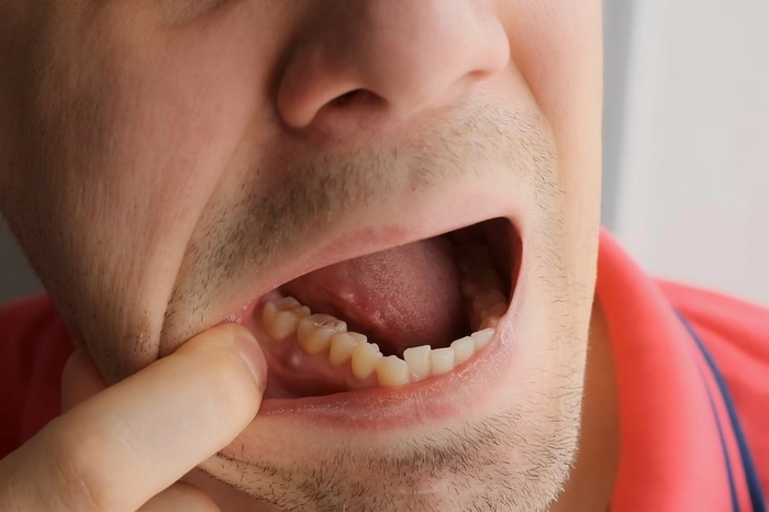 barbat care sufera de abces dentar