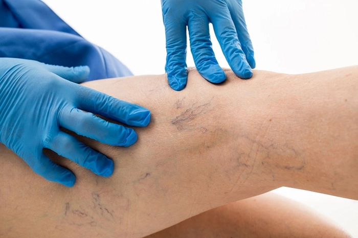medic care analizeaza picioarele unei persoane care sufera de varice
