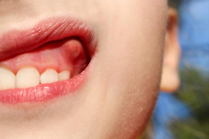 persoana care sufera de abces dentar