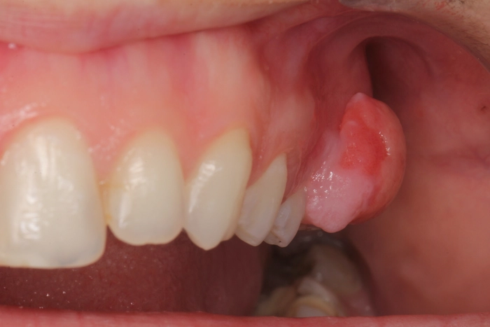 abces dentar