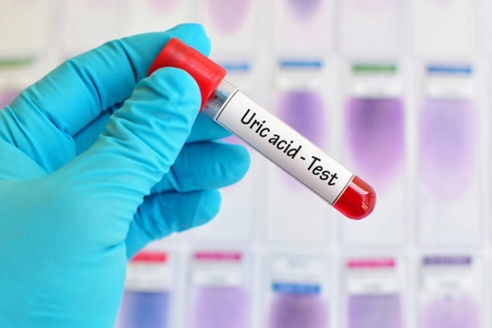analiza acid uric
