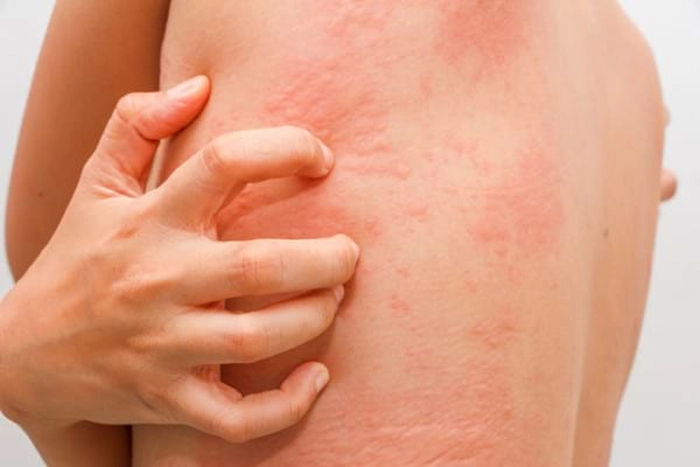 persoana care acuza mancarimi ale pielii