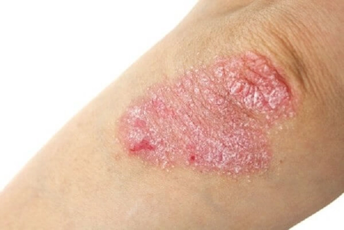 persoana care sufera de eczema