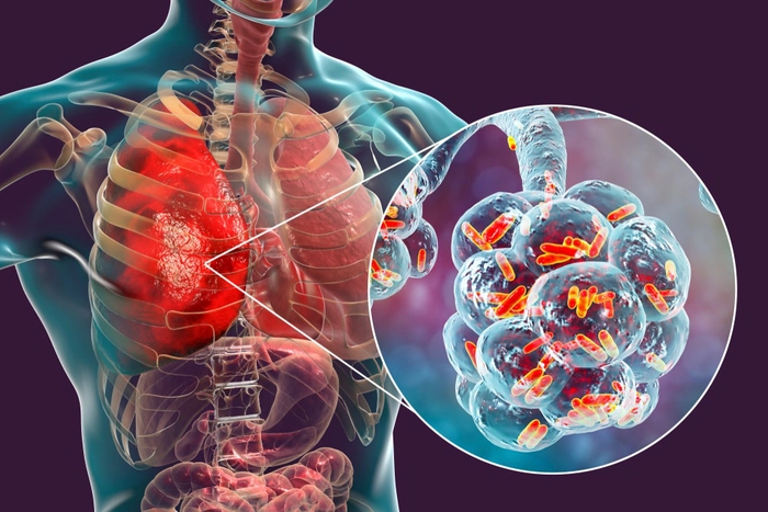 grafica plamani afectati de pneumonie