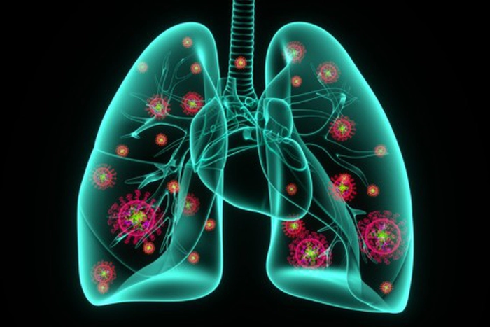 grafica plamani afectati de pneumonie
