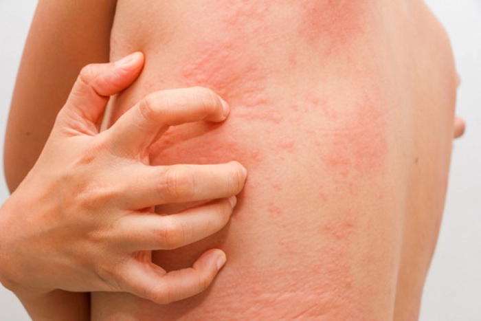 persoana care are bube aparute in urma unei toxiinfectii alimentare