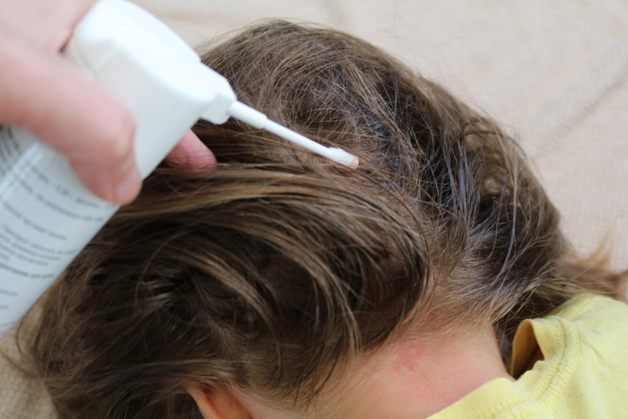 persoana care aplica o solutie pe scalpul unei persoane